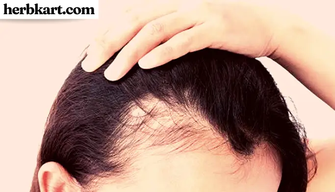 Hair Loss Types & Causes - Herbkart