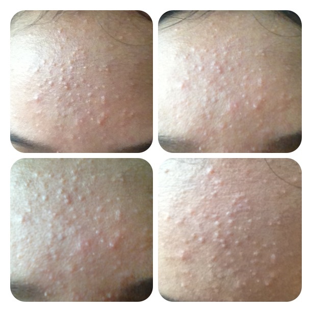 1BOX*15G NIZORALCREAM 15 G Treatment of acne, inflammatory acne945704