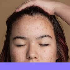 1BOX*15G NIZORALCREAM 15 G Treatment of acne, inflammatory acne945705